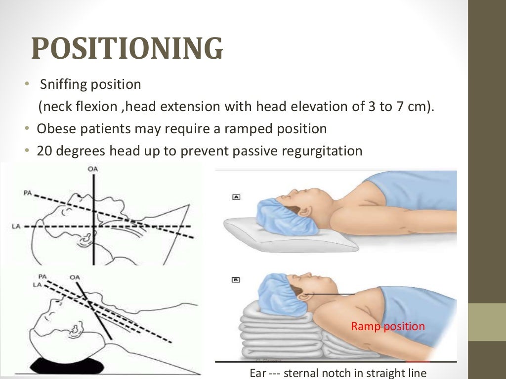 Rapid Sequence Induction & Intubation