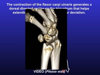 The contraction of the flexor carpi ulnaris generates a
 dorsal directed vector on the triquetrum that helps
   extending the proximal row in ulnar deviation.




                 VIDEO (Please wait)
 