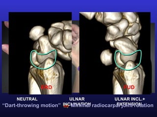 ERD                              FUD

     NEUTRAL              ULNAR             ULNAR INCL.+
“Dart-throwing motion” INCLINATION radiocarpal joint rotation
                           Minimal           EXTENSION
 