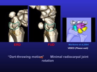 ERD                   FUD           Moritomo et al,2004
                                      VIDEO (Please wait)



“Dart-throwing motion”     Minimal radiocarpal joint
                     rotation
 