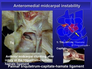 Anteromedial midcarpal instability



         H           C

        1
             2

   Tq                                1: Triquetrum - Hamate
                                                 2: Triquetrum -
                                     Capitate


 Anterior midcarpal clunking after
injury ot the triquetrum-capitate-
hamate ligament
  Palmar triqutetrum-capitate-hamate ligament
 