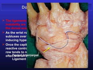 Dorsal midcarpal clunking


 The ligaments mostly involved in the dorsal midcarpal
  instability are the radioscaphocapitate ligament, and
  the dorsal scaphotriquetral ligament.
 As the wrist rotates toward ulnardevation the capitate
  subluxes over the edge of the scapholunate socket
  inducing hyperextension of the proximal row.
 Once the capitate is subluxed dorsally there is a
  reactive contraction of wrist extensors and the distal
  row tends to return abruptly to its normal alignment
       Dorsal Intercarpal
  often with an audible clunk.
       Ligament
 