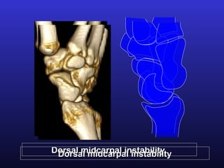 Dorsal midcarpal instability
 Dorsal midcarpal instability
 