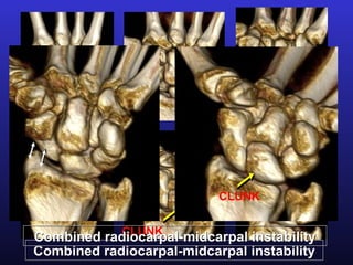 CLUNK

            CLUNK
Combined radiocarpal-midcarpal instability
Combined radiocarpal-midcarpal instability
 