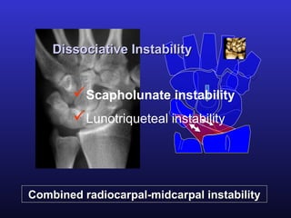 Dissociative Instability


        Scapholunate instability
        Lunotriqueteal instability



Combined radiocarpal-midcarpal instability
 