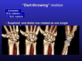 “Dart-throwing” motion
  Complete
 SLIL Complete
      rupture
    SLIL rupture

 Scaphoid and distal row rotated as one single
  functional unit.
 Reduced position of scaphoid in radial extesion.
 Dorsolateral subluxation of scaphoid in ulnar flexion.
 Wide gap between the scaphoid and lunate in ulnar
  flexion.
 Trapezium does not rotate about the distal scaphoid.
 No scaphocapitate motion.
 