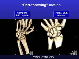 “Dart-throwing” motion

 Complete                            Partial SLIL
SLIL rupture                          rupture




               VIDEO (Please wait)
 