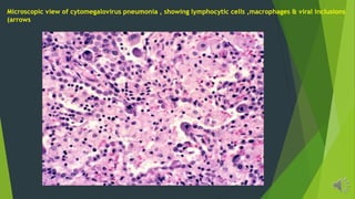 Microscopic view of cytomegalovirus pneumonia , showing lymphocytic cells ,macrophages & viral inclusions
(arrows
 