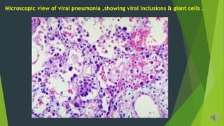 Microscopic view of viral pneumonia ,showing viral inclusions & giant cells .
 