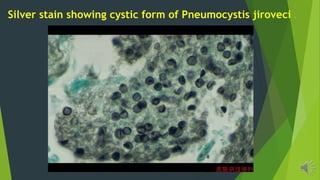 Silver stain showing cystic form of Pneumocystis jiroveci .
 