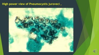 High power view of Pneumocystis juroveci ,
 