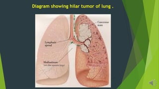Diagram showing hilar tumor of lung .
 