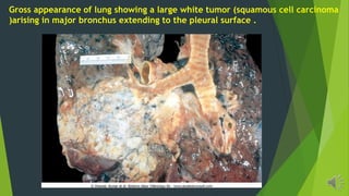 Gross appearance of lung showing a large white tumor (squamous cell carcinoma
)arising in major bronchus extending to the pleural surface .
 