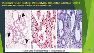 Microscopic views of lung tissue showing atypical adenomatous hyperplasia ,which is
considered as a precursor lesion for adenocarcinoma
 