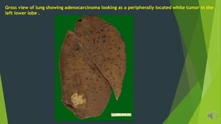 Gross view of lung showing adenocarcinoma looking as a peripherally located white tumor in the
left lower lobe .
 