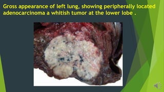 Gross appearance of left lung, showing peripherally located
adenocarcinoma a whitish tumor at the lower lobe .
 