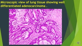 Microscopic view of lung tissue showing well
differentiated adenocarcinoma .
 