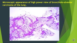 Microscopic appearance of high power view of bronchiolo-alveolar
carcinoma of the lung .
 