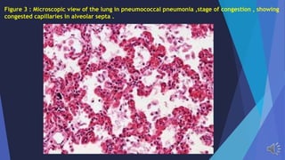 Figure 3 : Microscopic view of the lung in pneumococcal pneumonia ,stage of congestion , showing
congested capillaries in alveolar septa .
 