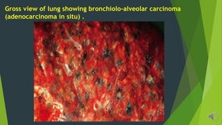 Gross view of lung showing bronchiolo-alveolar carcinoma
(adenocarcinoma in situ) .
 