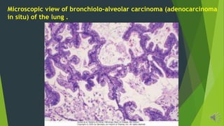 Microscopic view of bronchiolo-alveolar carcinoma (adenocarcinoma
in situ) of the lung .
 
