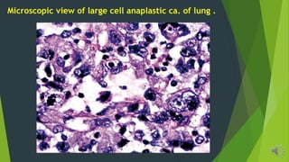 Microscopic view of large cell anaplastic ca. of lung .
 