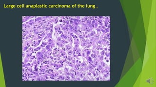 Large cell anaplastic carcinoma of the lung .
 