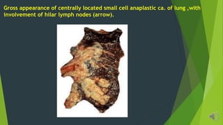 Gross appearance of centrally located small cell anaplastic ca. of lung ,with
involvement of hilar lymph nodes (arrow).
 