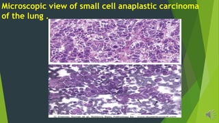 Microscopic view of small cell anaplastic carcinoma
of the lung .
 