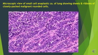 Microscopic view of small cell anaplastic ca. of lung showing sheets & ribbons of
closely-packed malignant rounded cells.
 