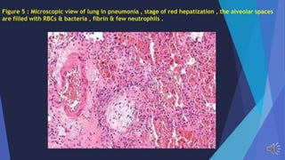 Figure 5 : Microscopic view of lung in pneumonia , stage of red hepatization , the alveolar spaces
are filled with RBCs & bacteria , fibrin & few neutrophils .
 