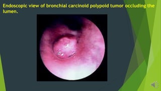 Endoscopic view of bronchial carcinoid polypoid tumor occluding the
lumen.
 