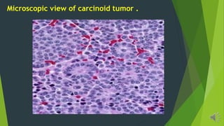 Microscopic view of carcinoid tumor .
 