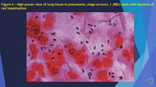 Figure 6 : High power view of lung tissue in pneumonia ,stage arrows). ) ,RBCs seen with bacteria of
red hepatization
 