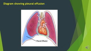 Diagram showing pleural effusion .
 