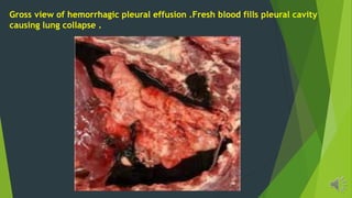Gross view of hemorrhagic pleural effusion .Fresh blood fills pleural cavity
causing lung collapse .
 