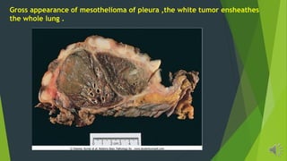 Gross appearance of mesothelioma of pleura ,the white tumor ensheathes
the whole lung .
 