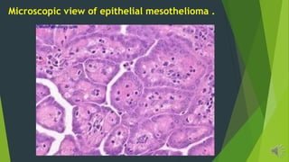 Microscopic view of epithelial mesothelioma .
 
