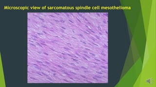 Microscopic view of sarcomatous spindle cell mesothelioma .
 
