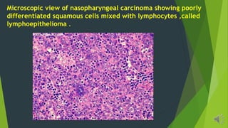 Microscopic view of nasopharyngeal carcinoma showing poorly
differentiated squamous cells mixed with lymphocytes ,called
lymphoepithelioma .
 