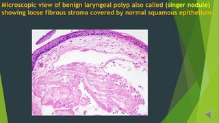 Microscopic view of benign laryngeal polyp also called (singer nodule)
showing loose fibrous stroma covered by normal squamous epithelium .
 