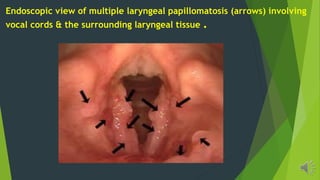 Endoscopic view of multiple laryngeal papillomatosis (arrows) involving
vocal cords & the surrounding laryngeal tissue .
 