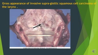 Gross appearance of invasive supra-glottic squamous cell carcinoma of
the larynx .
 