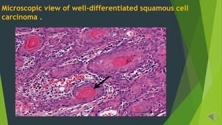 Microscopic view of well-differentiated squamous cell
carcinoma .
 