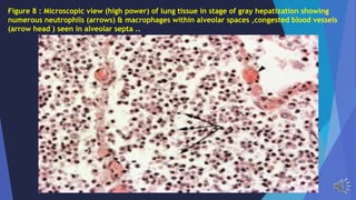Figure 8 : Microscopic view (high power) of lung tissue in stage of gray hepatization showing
numerous neutrophils (arrows) & macrophages within alveolar spaces ,congested blood vessels
(arrow head ) seen in alveolar septa ..
 