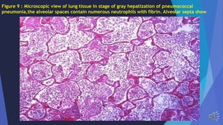 Figure 9 : Microscopic view of lung tissue in stage of gray hepatization of pneumococcal
pneumonia,the alveolar spaces contain numerous neutrophils with fibrin. Alveolar septa show
 