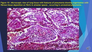 Figure 10 : Microscopic view of lung tissue with features of pneumonia showing organization with
fibrous tissue deposition on fibrin in alveolar spaces , occurring in unresolved pneumonia .
 