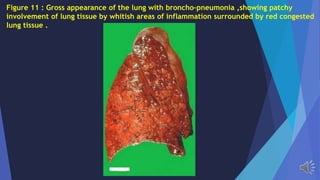 Figure 11 : Gross appearance of the lung with broncho-pneumonia ,showing patchy
involvement of lung tissue by whitish areas of inflammation surrounded by red congested
lung tissue .
 