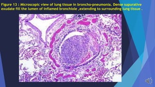 Figure 13 : Microscopic view of lung tissue in broncho-pneumonia. Dense supurative
exudate fill the lumen of inflamed bronchiole ,extending to surrounding lung tissue .
 