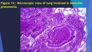 Figure 14 : Microscopic view of lung involved in broncho-
pneumonia .
 
